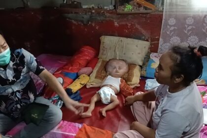 Kondisi Goffi bayi derita Hidrosefalus di Subang hanya bisa terbaring di kasur dengan kondisi kepala membesar (FOTO: KOMPAS.COM / AHYA NURDIN)(Ahya Nurdin )